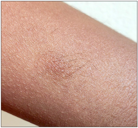 Nodular lesion present over the left arm with overlying hyperpigmentation and hypertrichosis.