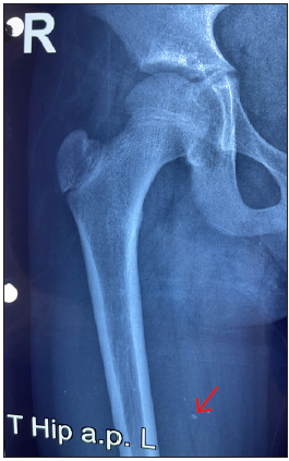 X-ray of the right thigh showing radio-opaque shadow (red arrow) suggestive of calcification.