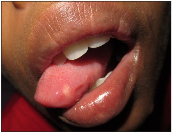 Oral cavity showing a solitary white nodule present on the lateral aspect of the tongue.