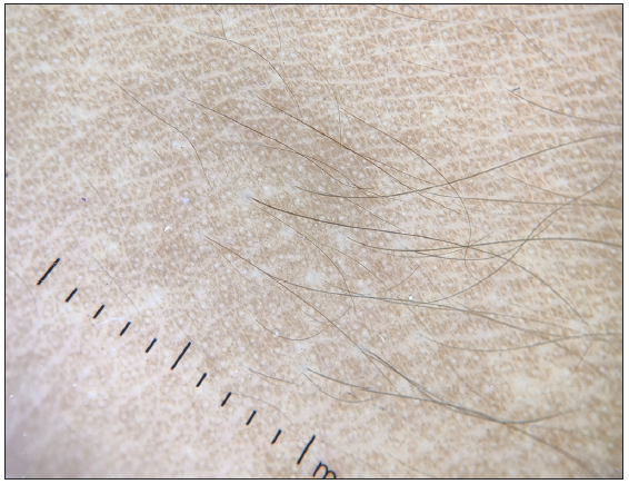 Dermoscopic examination showed diffuse structureless pigmentation with areas of perifollicular sparing (DermLite DL4 dermoscopy 10x).