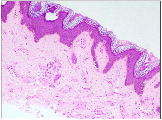 Histopathological examination showed normal epidermis and scattered large cells in the dermis (Haematoxylin & eosin, 100x).