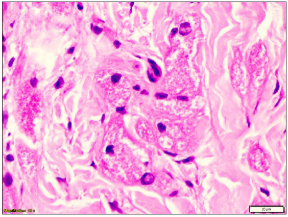 On higher magnification, large polygonal cells with eosinophilic granular cytoplasm and central nuclei in the upper dermis suggest granular cell tumour (Haematoxylin & eosin, 400x).