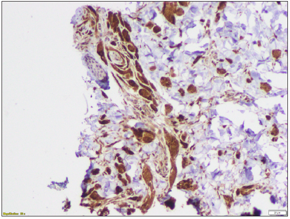 Immunohistochemistry of the histopathology showing tumour cells with CD68 positivity (Immunohistochemistry, 200x).