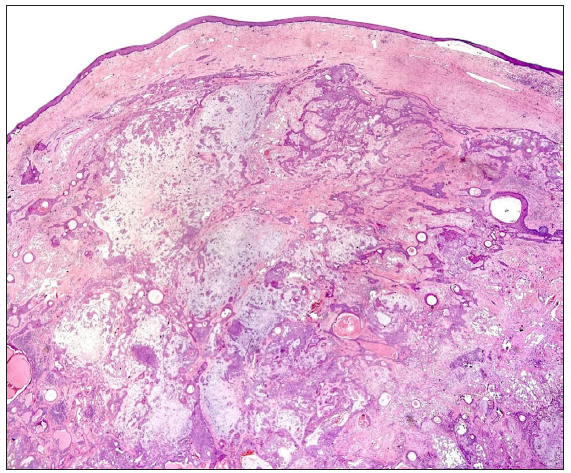 Histopathology showing a circumscribed lesion in the dermis with prominent chondromyxoid stroma. (Haematoxylin and eosin, 20x).