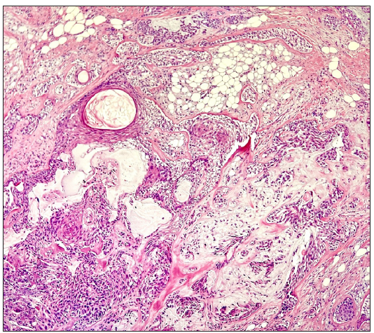 Histopathology showing a biphasic tumour showing follicular differentiation in the form of keratin cysts representing the epithelial component of the tumour along with cuboidal cell nests, myoepithelial cells and nests of adipocytes representing the mesenchymal components. (Haematoxylin and eosin, 100x).