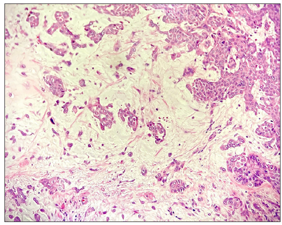 Histopathology showing myoepithelial cells admixed in a myxoid background. (Haematoxylin and eosin, 400x).