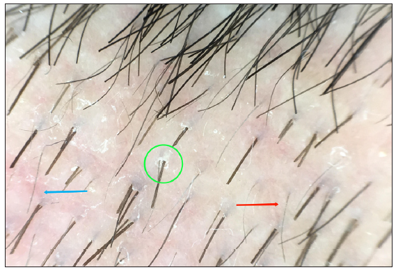 Trichoscopy showed dystrophic hairs (red arrow), mild erythema (blue arrow), and perifollicular white scales (green circle) (Beining, polarised light, ×20).