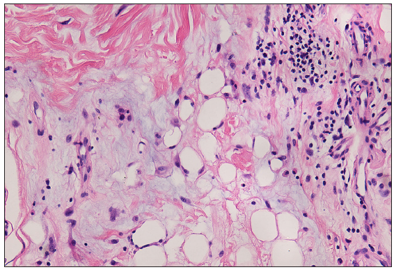 Lymphocyte-based infiltration in the fat lobules with abundant mucin deposition (Haematoxylin and eosin, 200x).