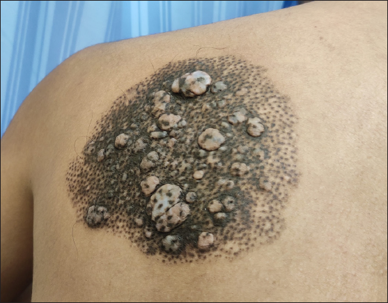 A well-circumscribed lesion on the back consisting of multiple brownish-black to bluish hyperpigmented macules and multiple soft well-circumscribed papules and nodules.