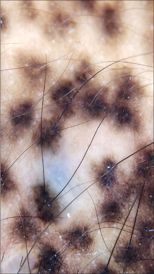 Dermoscopy showing follicle-centred brownish-black to bluish pigmentation with a reticulo-globular pattern and intervening normal skin (DermLite DL3N; contact, polarised, 10x).