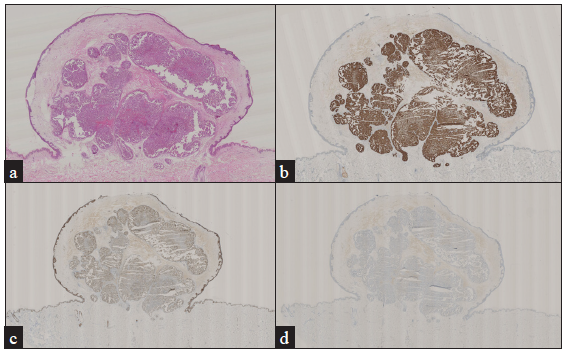 (a) Eosinophilic cytoplasmic tumour cell clusters in the dermis (Haematoxylin and eosin, 15x), (b) Positive immunohistochemical staining for CK7 (15x), (c) Positive immunohistochemical staining for p63 (15x), (d) Negative immunohistochemical staining for CK20 (15x).