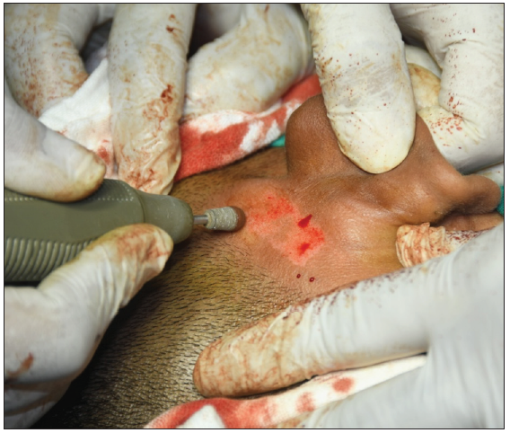 De-epidermisation of the donor site (retroauricular area).