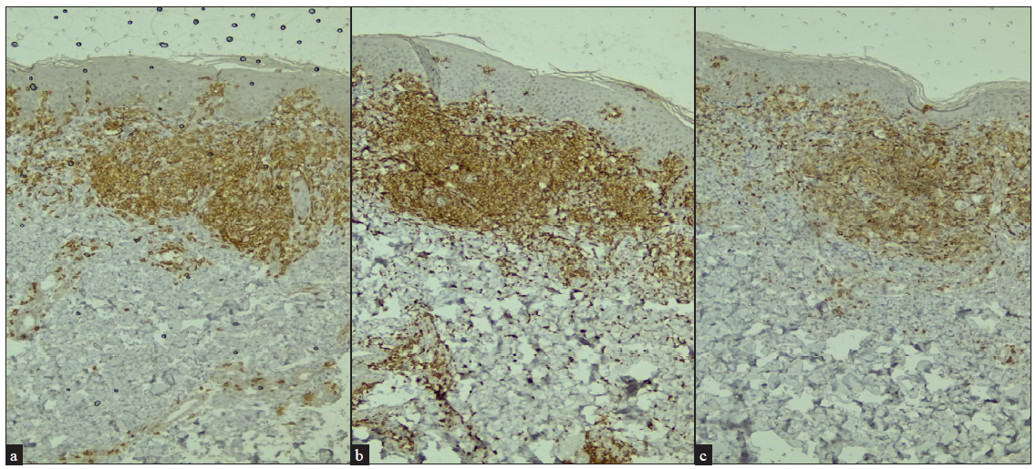 Immunohistochemistry (IHC) on skin biopsy shows (a) CD3+, (b) CD4+ and (c) relative loss of expression of CD7 (20x).