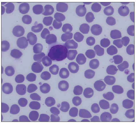 Sézary cell in peripheral blood smear.