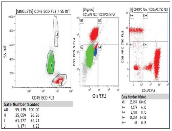 Immunophenotyping of whole blood shows 26% CD45 bright population of lymphoid cells, and CD4/CD8 ratio >10, diagnostic of Sezary syndrome.