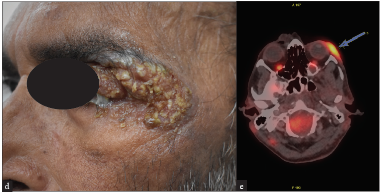 (d) Plaque stage of MF on the left peri-orbital area and (e) Increased 18F-FDG uptake in the plaque. (FDG: Fluorodeoxyglucose.)