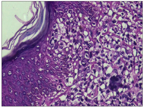 Collection in atypical lymphocytes in clusters in the epidermis (Pautrier’s microabscesses) from a case of plaque stage of MF. (Haematoxylin & eosin, 40x)