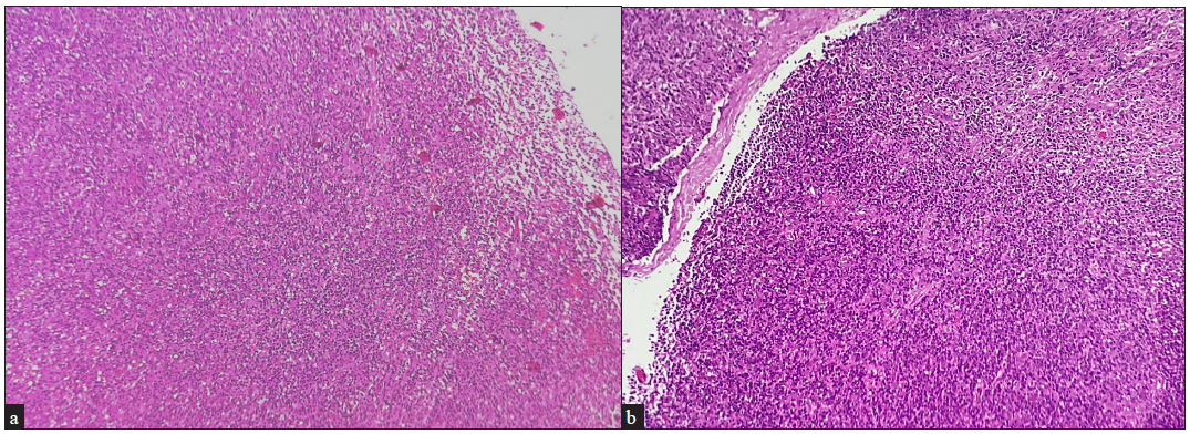 Scanner and low magnification view of a lymph node showing complete effacement of the lymph node architecture (a) Haematoxylin & eosin, 10x), (b) (Haematoxylin & eosin, 20x).