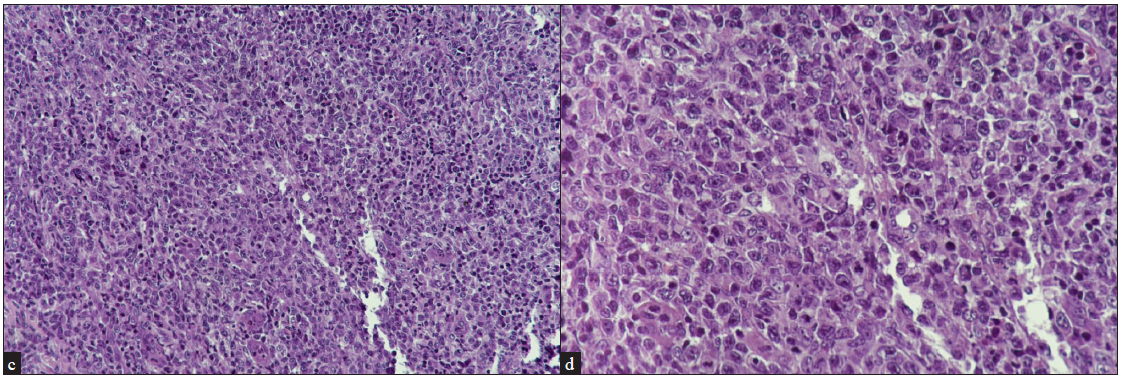 Lymph node biopsy (c) Diffuse infiltration of the lymph node by lymphoid cells lying singly as well as in clusters (Haematoxylin and eosin, 20x), (d) These lymphocytes are irregular in morphology with atypical nuclei with coarse vesicular chromatin (Haematoxylin and eosin, 40x).