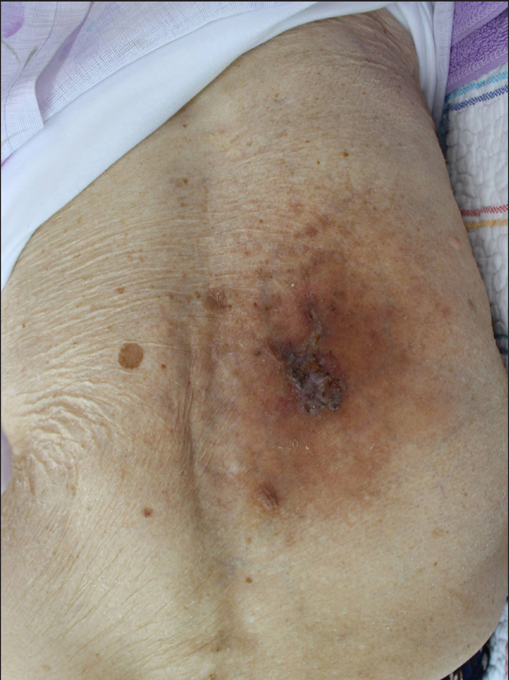 The size and thickness of the lesion reduced after 7 months of treatment