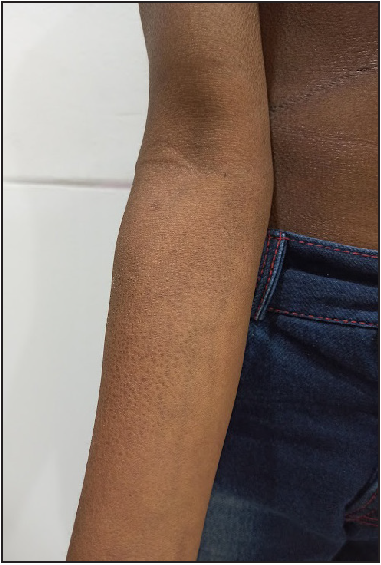 Dark-brown, adherent scales over the forearm with relative sparing of the cubital fossa.