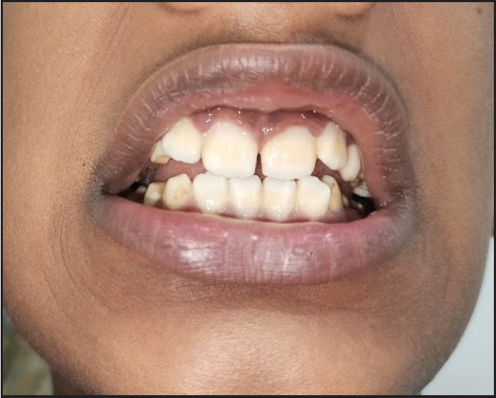 Hypoplastic dental enamel.