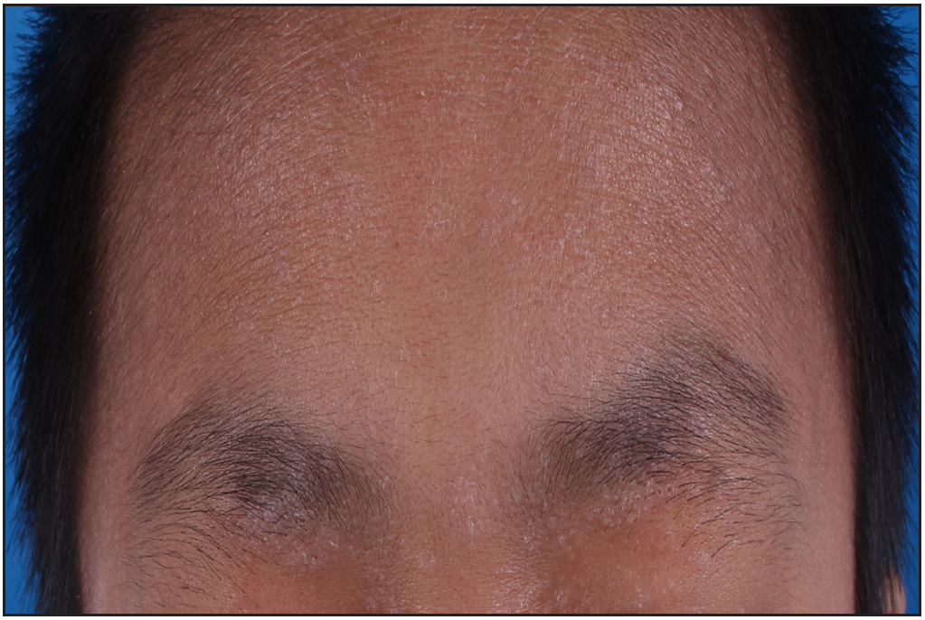 Erythema and xerosis on the forehead and eyelids before treatment.