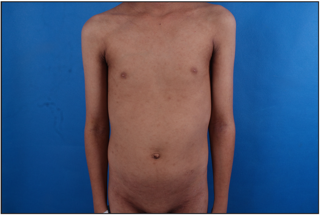 Erythema and xerosis on the trunk and upper limbs before treatment.