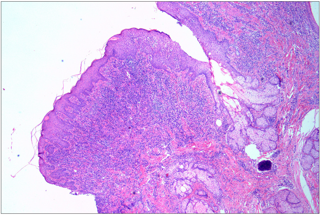 A skin biopsy from the oral nodule showing significant infiltration of histocytes, lymphocytes, and eosinophilic granulocytes in the superficial mid-layer of the dermis, consistent with cutaneous granulomatosis (Haematoxylin and eosin, original magnification × 40).