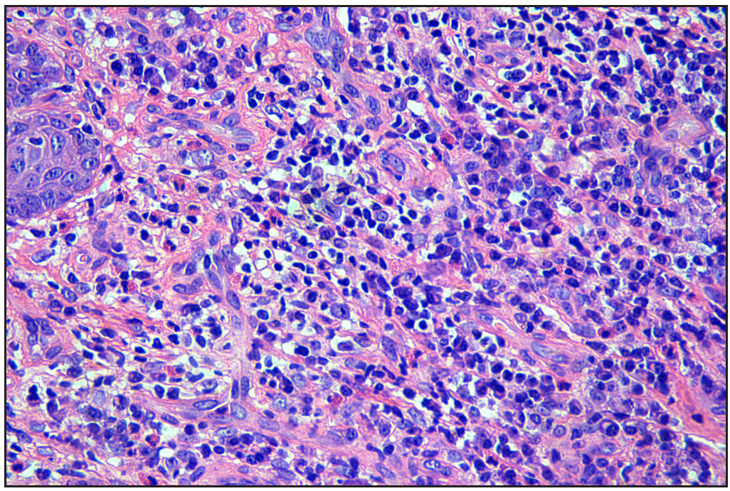 A skin biopsy from the oral nodule showing a significant infiltration of histocytes, lymphocytes, and eosinophilic granulocytes in the superficial mid-layer of the dermis, consistent with cutaneous granulomatosis (Haematoxylin and eosin, original magnification × 400).