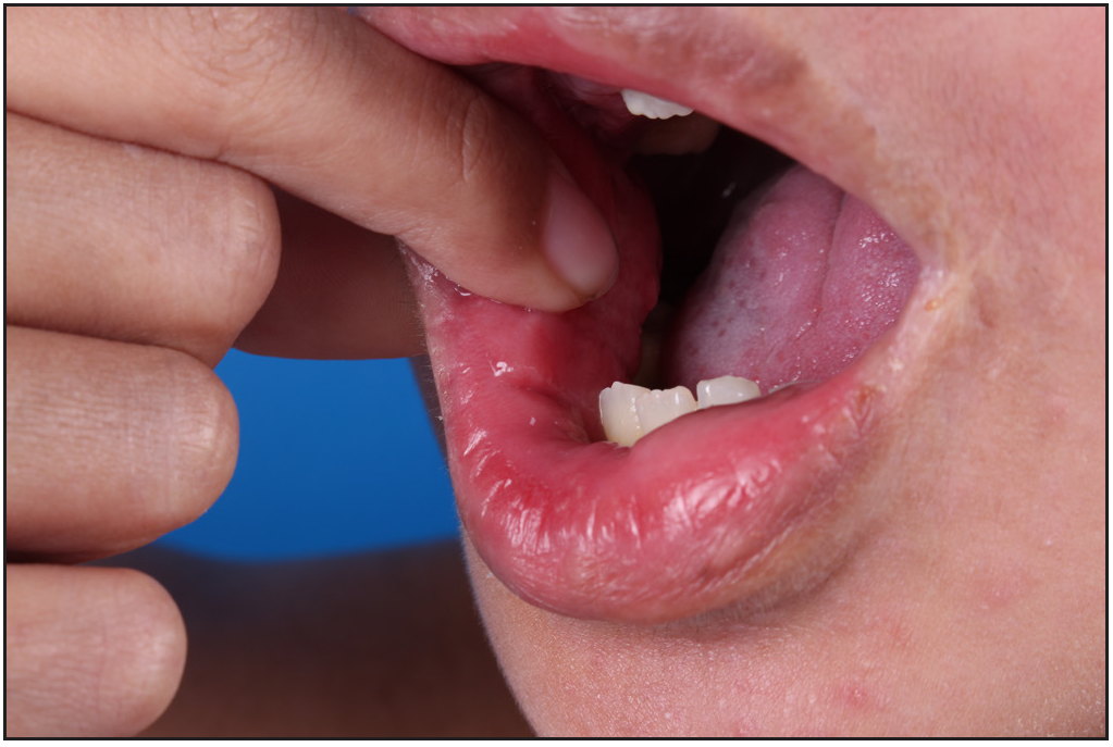 Granulomatosis-like mass in the right buccal mucosa disappeared after 8 weeks of dupilumab therapy.