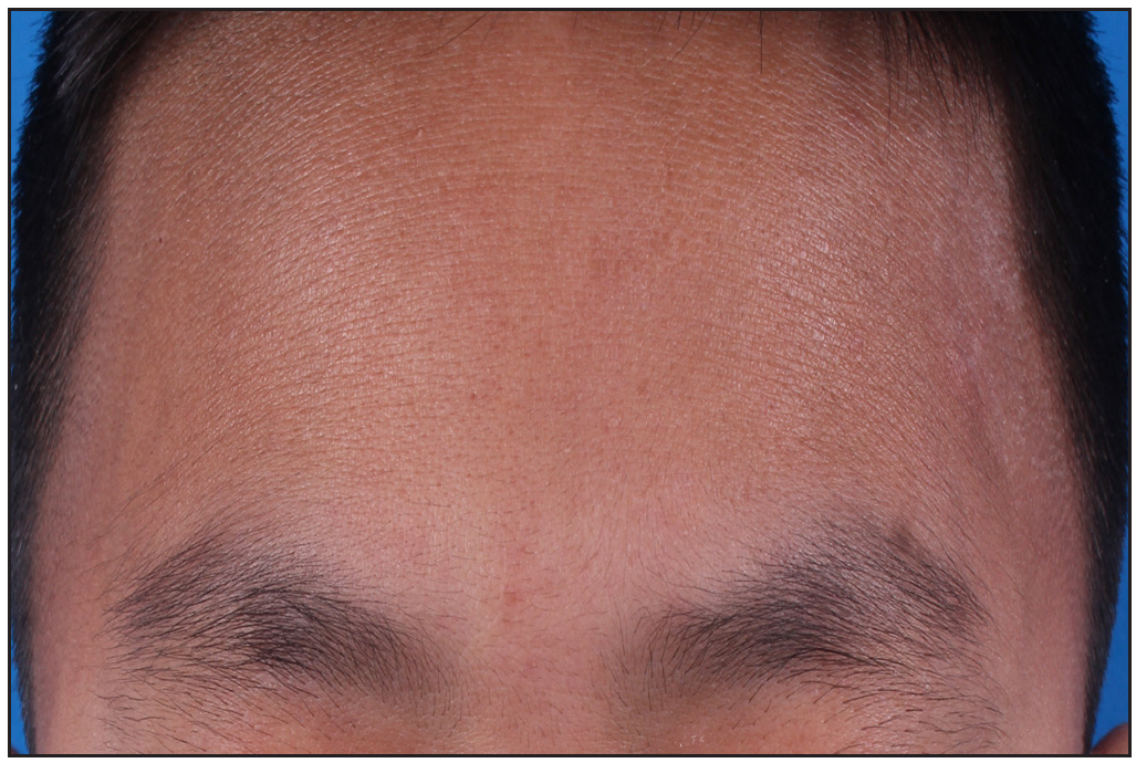 Erythema and xerosis on the forehead and eyelids disappeared after 8 weeks of dupilumab therapy.