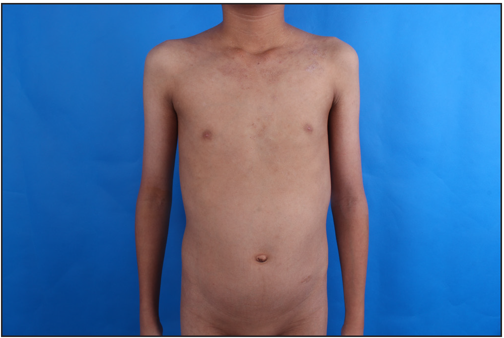 Erythema and xerosis on the trunk and upper limbs disappeared after 8 weeks of dupilumab therapy.