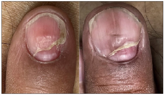 Resolution of swelling, ulceration crusting with onychomadesis.