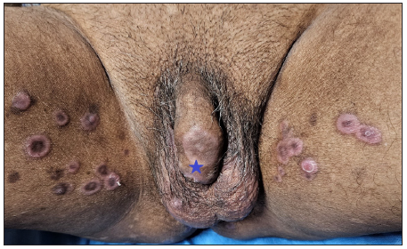 Multiple psoriasiform annular plaques present on bilateral inner thighs, scrotum and penile shaft (Blue star).