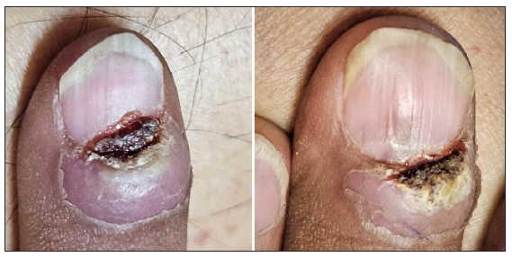 Left hand’s fifth digit shows crusted ulceration encroaching the nail bed and the right hand’s third digit shows swelling with overlying crusted ulceration.