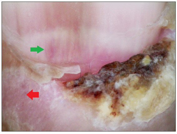 Pre-treatment: Brown crusting, swelling and short linear vessels on PNF (red arrow) and nail bed vascularity (green arrow) of 3rd digit of right hand (Dino-lite AM7115MZT, non-contact, polarised mode, 50x).