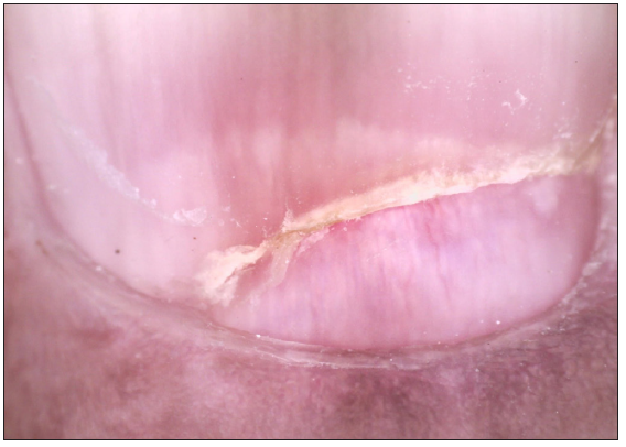 Post treatment: Oychomadesis with proximal nail fold devoid of any lesion on right 3rd digit (Dino-lite AM7115MZT, non-contact, polarised mode, 50x).