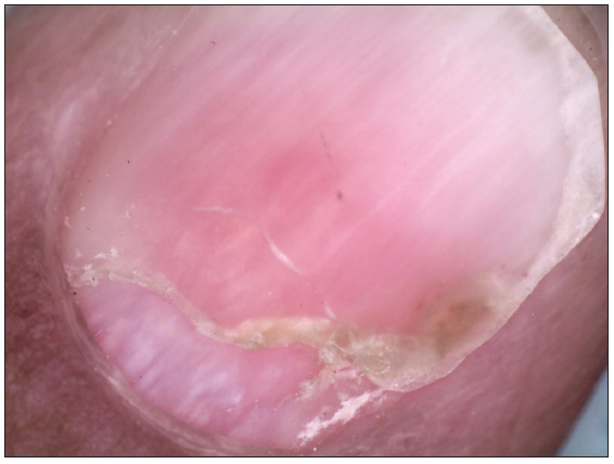 Post treatment: Onychomadesis with normal proximal nail fold of left 5th digit (Dino-lite AM7115MZT, non-contact, polarised mode, 50x).