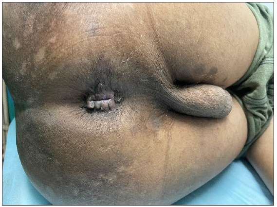 Resolution of perianal lesion with hyperpigmentation.