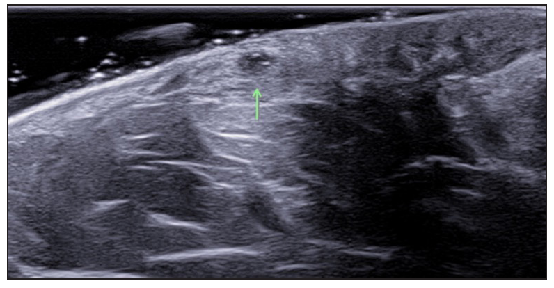 Multiple fluid collections (green arrow), SOS-HS stage II.