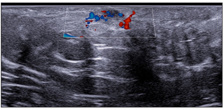 Moderate vascularisation at periphery of fistulous tracts on colour doppler (Dotted rectangle represents the area with vascularity within the active site of involvement).