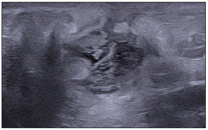 Multiple fluid collections invading the fistulous tract and hypodermal hyperechogenic oedema.