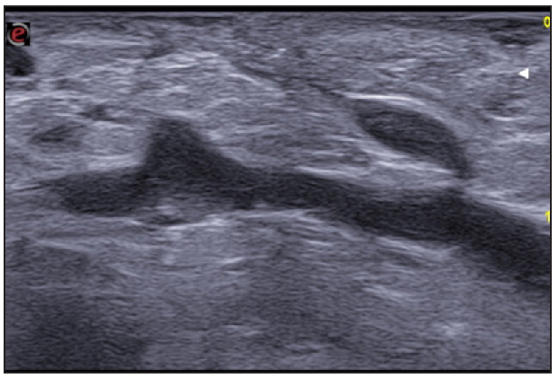 Fistulous tracts in SOS-HS Stage III; with fibrotic scarring invading the fistulous tract and hypodermal hyperechogenic oedema. (SOS-HS: Sonographic staging of hidradenitis suppurativa.)