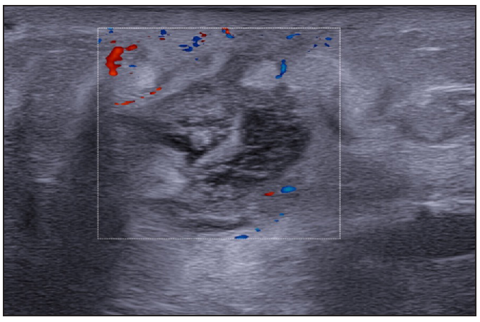 Moderate vascularisation at the periphery and internal of fistulous tracts on colour doppler (Dotted rectangle represents the area with vascularity within the active site of involvement).