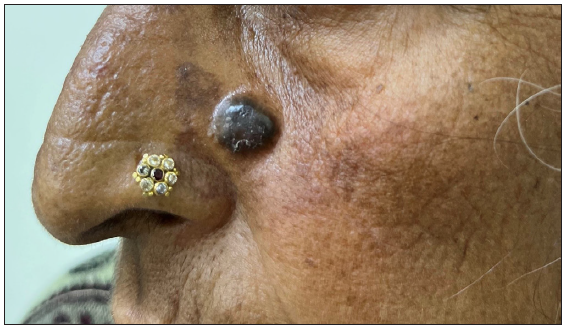 A case of nodular pigmented basal cell carcinoma over the lateral wall of the nose.