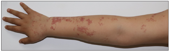 Banded telangiectasia patches on the right upper limb of patient 10.