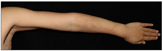 Skin lesions of patient 5 before treatment.