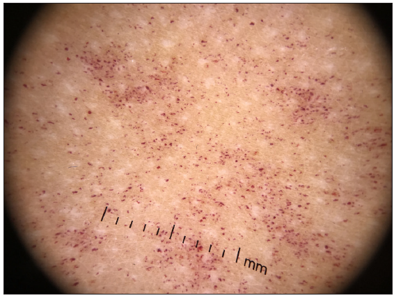 Dermatoscopic findings before treatment (DermLite, polarised light, 10x).