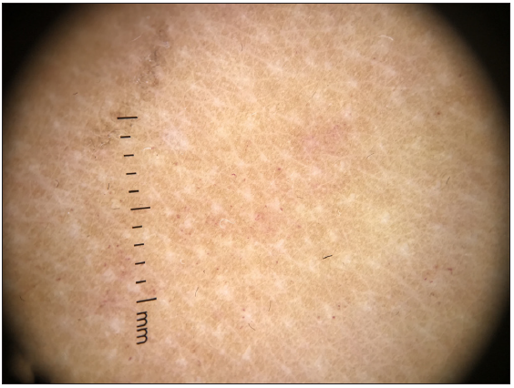 Dermatoscopic findings after treatment (DermLite, polarised light, 10x).